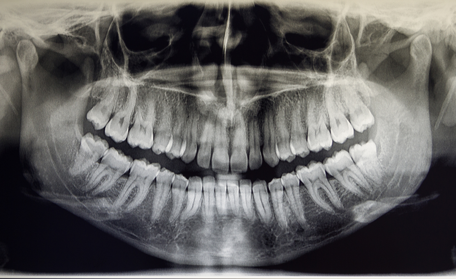 Orthopantomography of an adult patient, dentistry